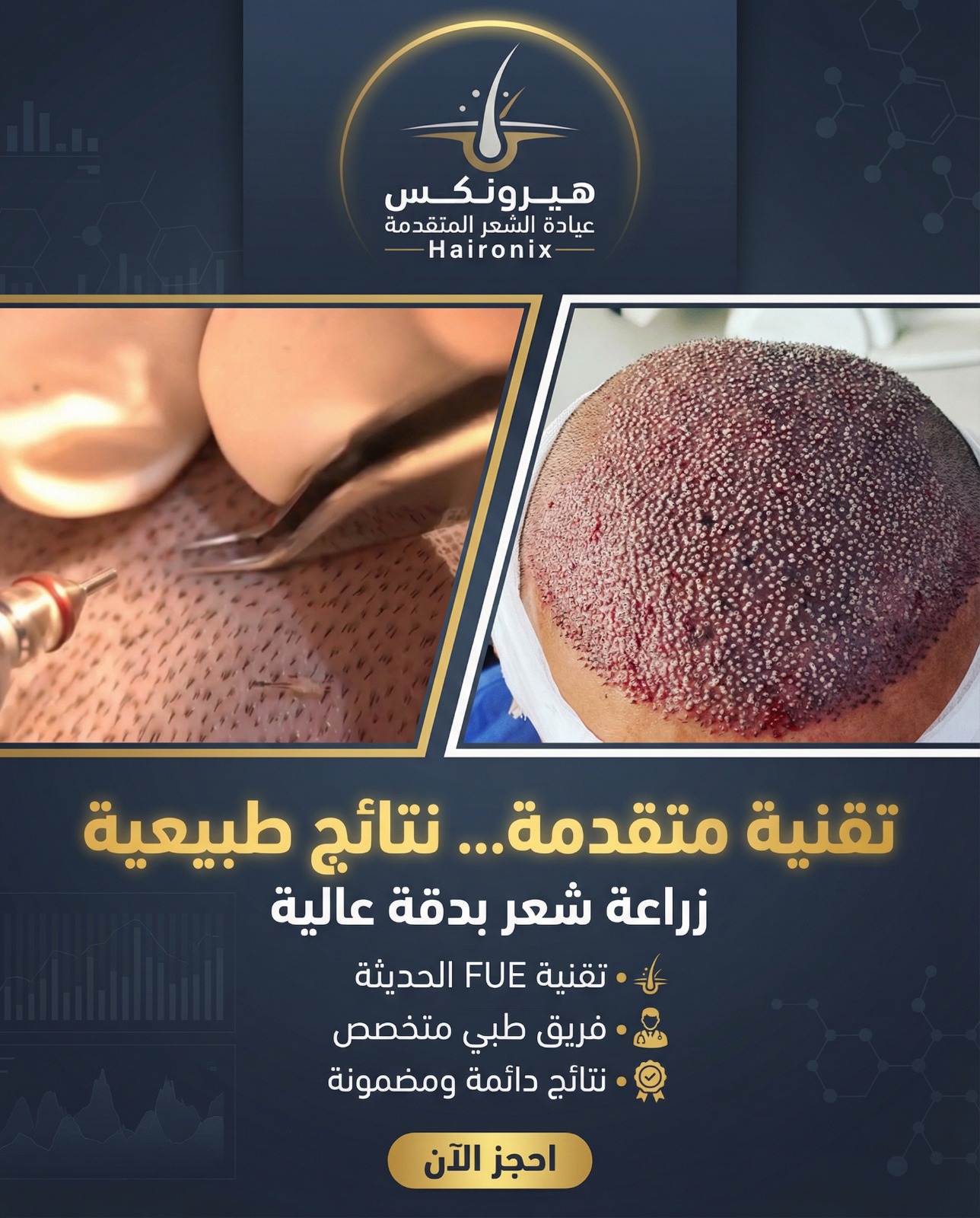 لماذا يعتبر هيرونكس (Haironix) أفضل مركز لزراعة الشعر بدقة عالية في مصر؟